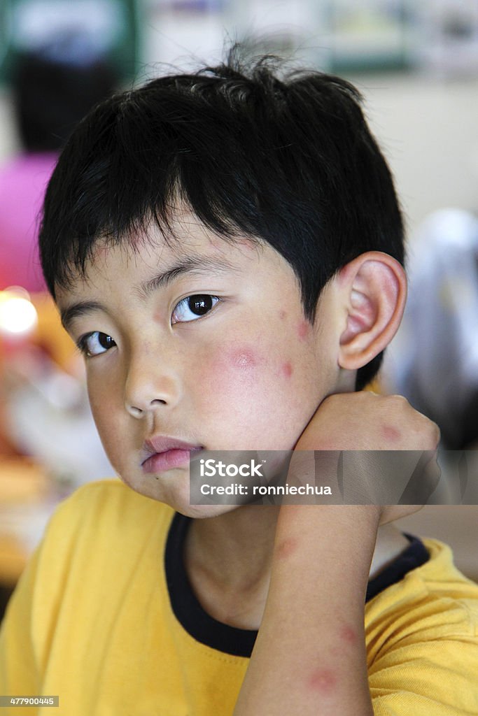 Dziecko z wielu Mosquito przekąski - Zbiór zdjęć royalty-free (Dziecko)