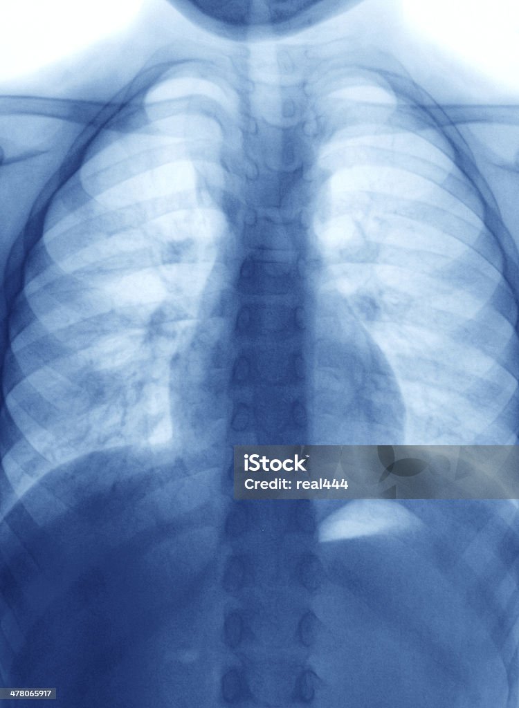 Chest X-ray image Vertebra xray Chest - Torso Stock Photo