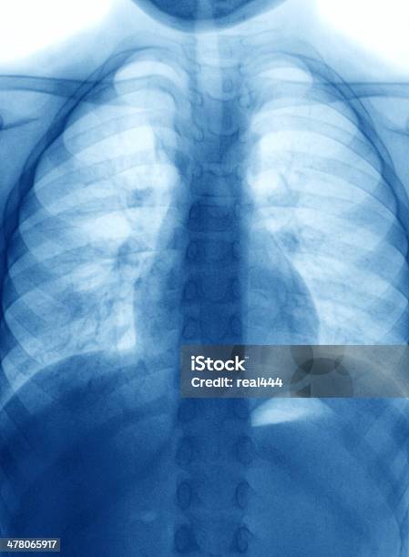 Chest Xray Image Stock Photo - Download Image Now - Chest - Torso, Clavicle, Close-up