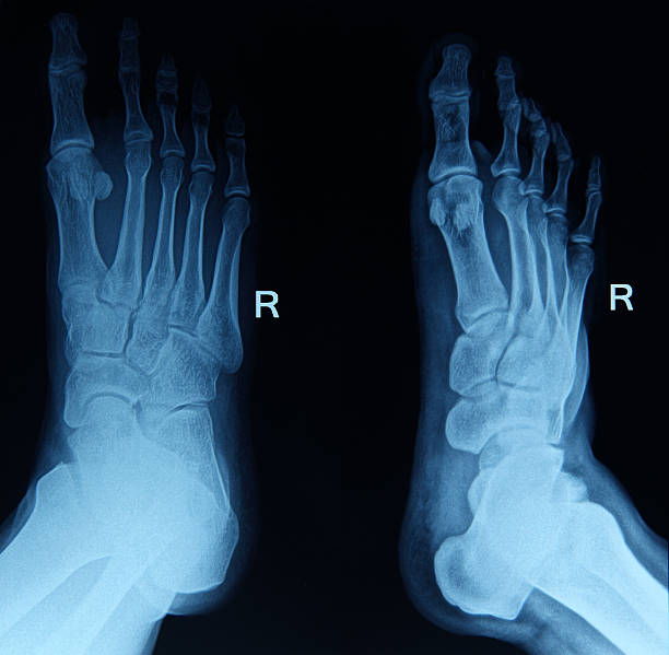 imagem de raios x do pé - bending human foot ankle x ray image - fotografias e filmes do acervo