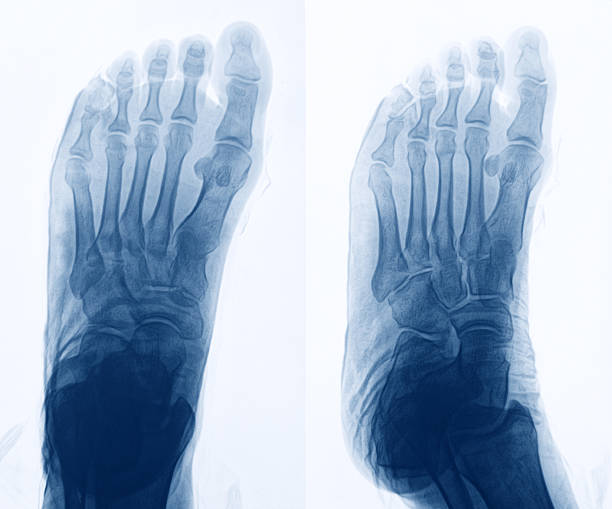 imagerie par rayons x des pieds - bending human foot ankle x ray image photos et images de collection