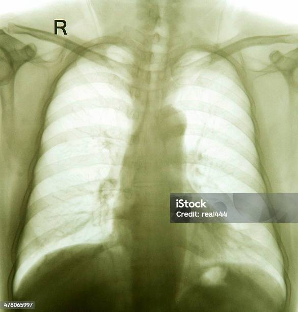 Photo libre de droit de Xray Image De La Poitrine banque d'images et plus d'images libres de droit de Articulation du corps humain - Articulation du corps humain, Articulations, Cage thoracique