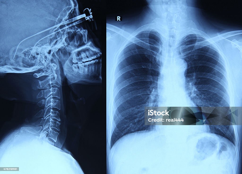 Röntgenbild - Lizenzfrei Anatomie Stock-Foto