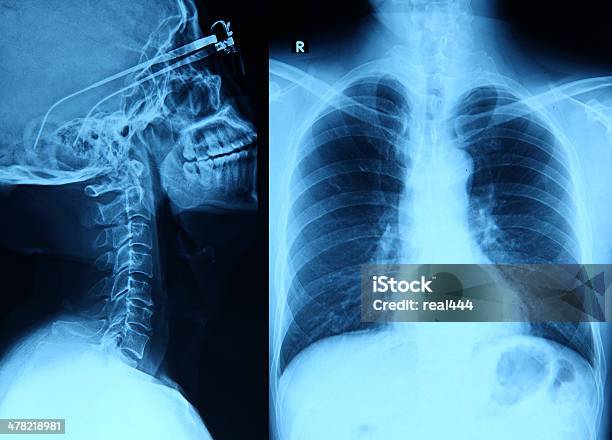 Röntgenbild Stockfoto und mehr Bilder von Anatomie - Anatomie, Beleuchtet, Bildkomposition und Technik