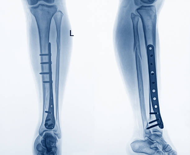 endoproteza stawu biodrowego - x ray human knee orthopedic equipment human bone zdjęcia i obrazy z banku zdjęć