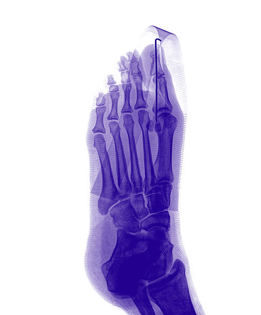 xray film x-ray show fracture proximal phalange at first toe pollex stock pictures, royalty-free photos & images