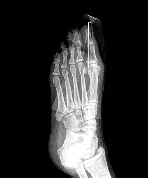 xray film x-ray show fracture proximal phalange at first toe pollex stock pictures, royalty-free photos & images