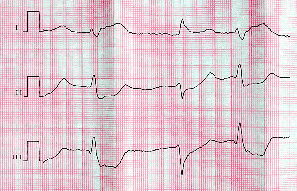 Ecg With Acute Period Of Myocardial Infarction Stock Photo