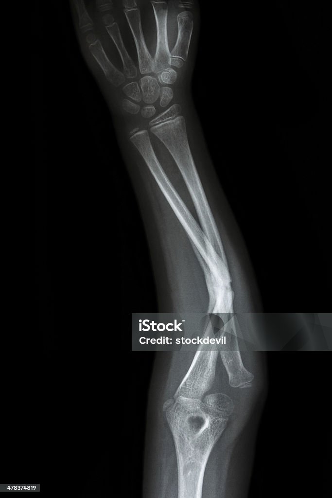 fracture shaft of ulnar(forearm's bone) film x-ray forearm AP : show fracture shaft of ulnar(forearm's bone) Adult Stock Photo