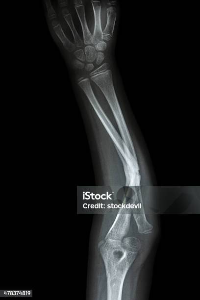 Fracture Shaft Of Ulnar Stock Photo - Download Image Now - Adult, Adults Only, Anatomy