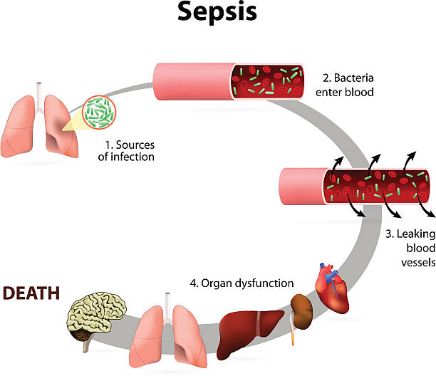 sepsis - endokarditis stock-grafiken, -clipart, -cartoons und -symbole