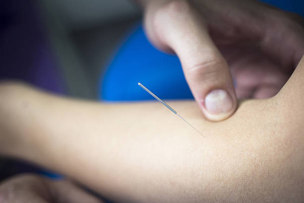 istock Doctor hand acupuncture needle patient arm 478502188