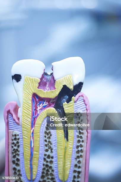 Dental Tooth Model Cast Showing Decay Enamel Roots Stock Photo - Download Image Now - 2015, Anatomical Model, Anatomy