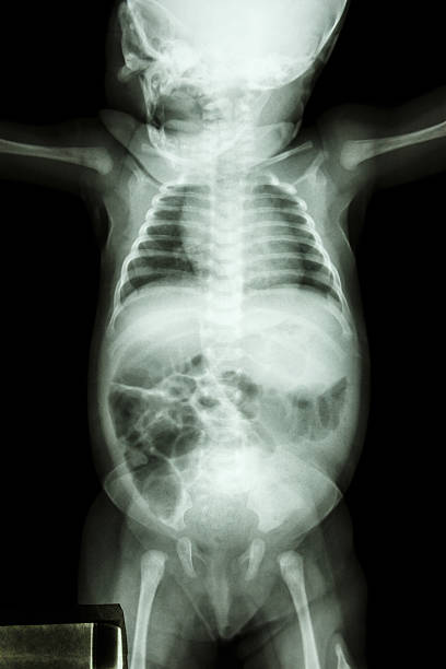 istock film x-ray whole infant's body 478532129
