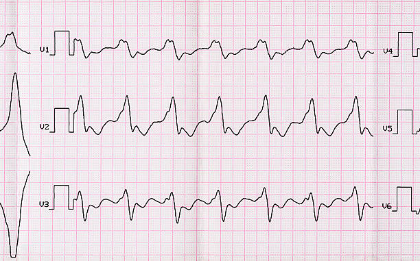 istock ECG with paroxysm correct form of atrial flutter 478649338