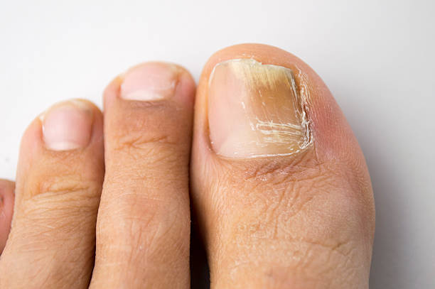 krankheitserregender nagel-infektion - menschlicher zeh stock-fotos und bilder