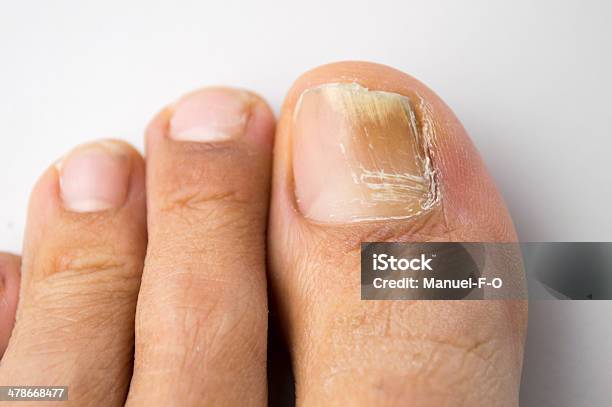 Fungal Nail Infection Stock Photo - Download Image Now - Toenail, Fungus, Fingernail