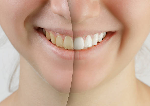 10 代の少女の笑顔、前に後の歯のホワイトニング - teenager teenage girls women dentist ストックフォトと画像