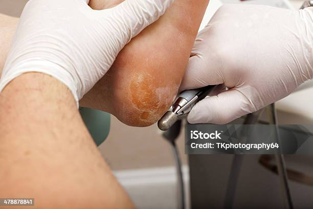 Trockene Haut An Der Ferse Stockfoto und mehr Bilder von Allgemeinarztpraxis - Allgemeinarztpraxis, Ausgedörrt, Ausrüstung und Geräte