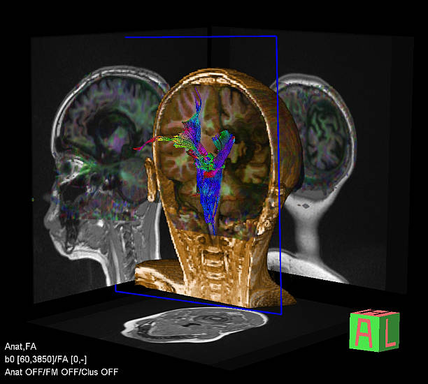 tractography (dti- tensor de difusão de imagens de mri) do cérebro - neuroscience mri scan brain brain surgery - fotografias e filmes do acervo