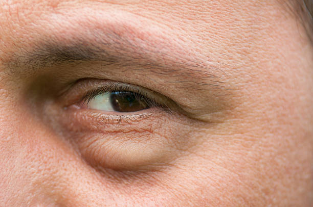 Eyesore, inflammation or bag swelling under eye stock photo