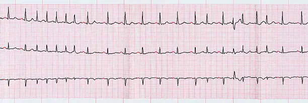 Photo of ECG with short paroxysms of atrial fibrillation