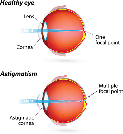 Astigmatism. Eye disease. Healthy eye and Astigmatic eye