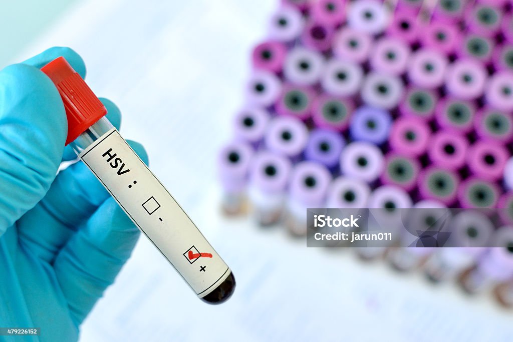Herpes positive Blood sample with HSV (Herpes Simplex Virus) positive 2015 Stock Photo