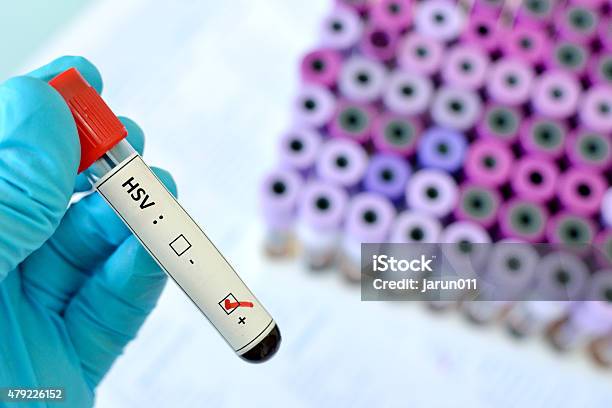 Herpes Positive Stock Photo - Download Image Now - 2015, Blood, Healthcare And Medicine