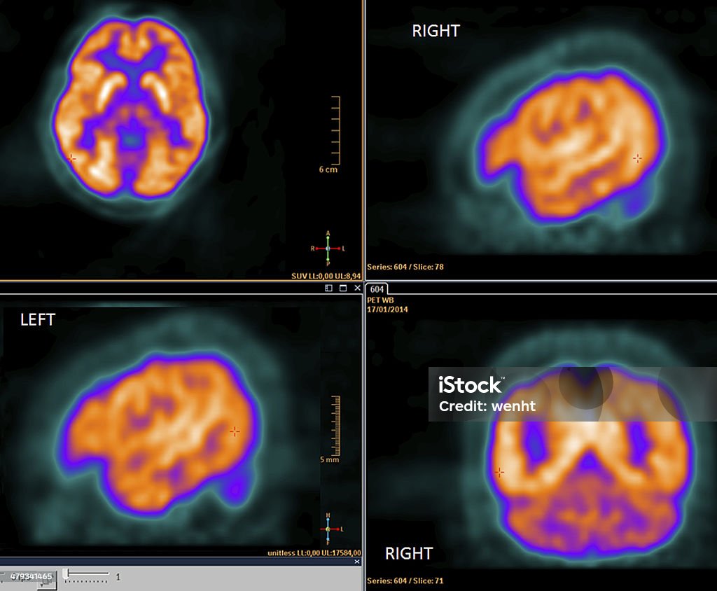 PET-CT Digitalize o cérebro - Foto de stock de Escaneamento royalty-free