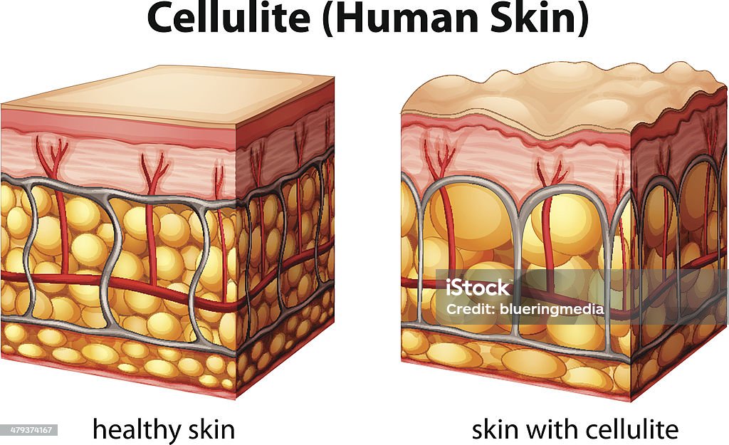 Cellulite - arte vectorial de Celulitis - Tipos de piel libre de derechos