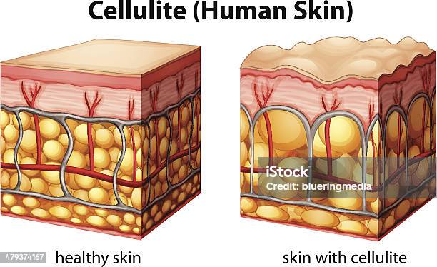 Ilustración de Cellulite y más Vectores Libres de Derechos de Celulitis - Tipos de piel - Celulitis - Tipos de piel, Corte transversal, Ilustración