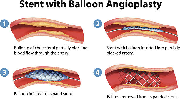 ilustraciones, imágenes clip art, dibujos animados e iconos de stock de angioplastia procedimiento de endoprótesis - angioplasty