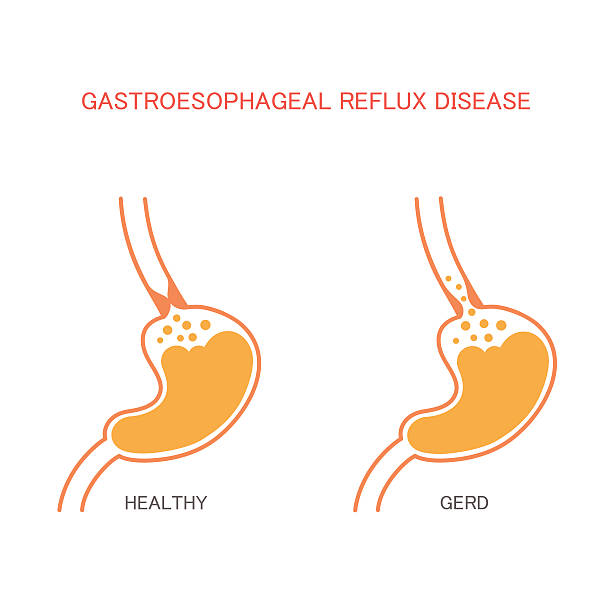 reflux  disease, reflux  disease, heartburn, stomach pain, human gastric acid  sphincter stock illustrations