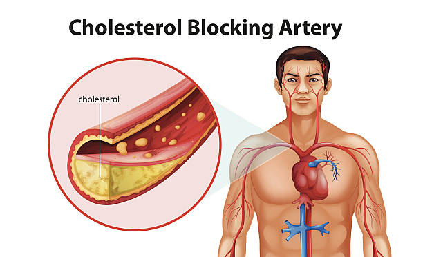 Ateriosclerosis Illustration showing the process of ateriosclerosis statin stock illustrations