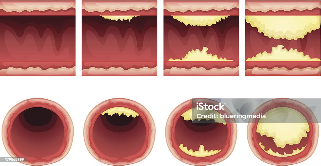 Ateriosclerosis Illustration showing the process of ateriosclerosis Atherosclerosis stock vector
