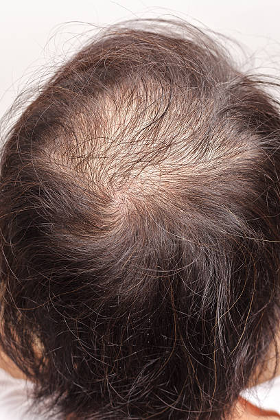 istock lose one's hair glabrous baldy loss 479595056