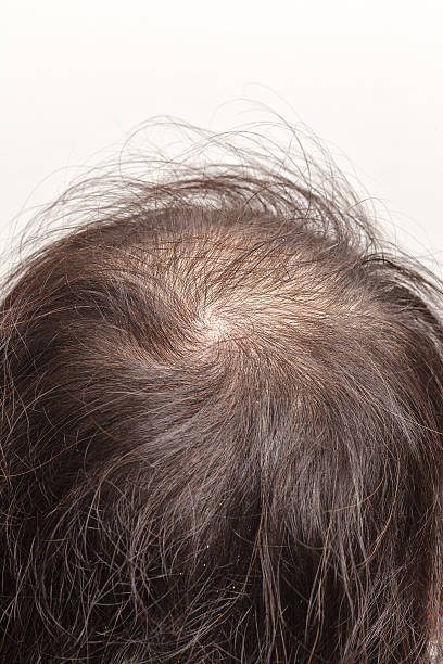 istock lose one's hair glabrous baldy loss 479595066