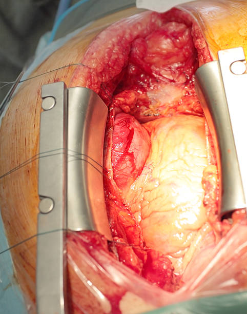 istock huge aneurysm of the left ventricle 479689790