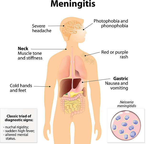 ilustrações, clipart, desenhos animados e ícones de meningite - meningite