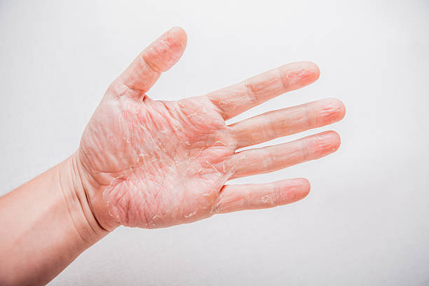 istock The problem with many people - eczema on hand. Isolated 479825786