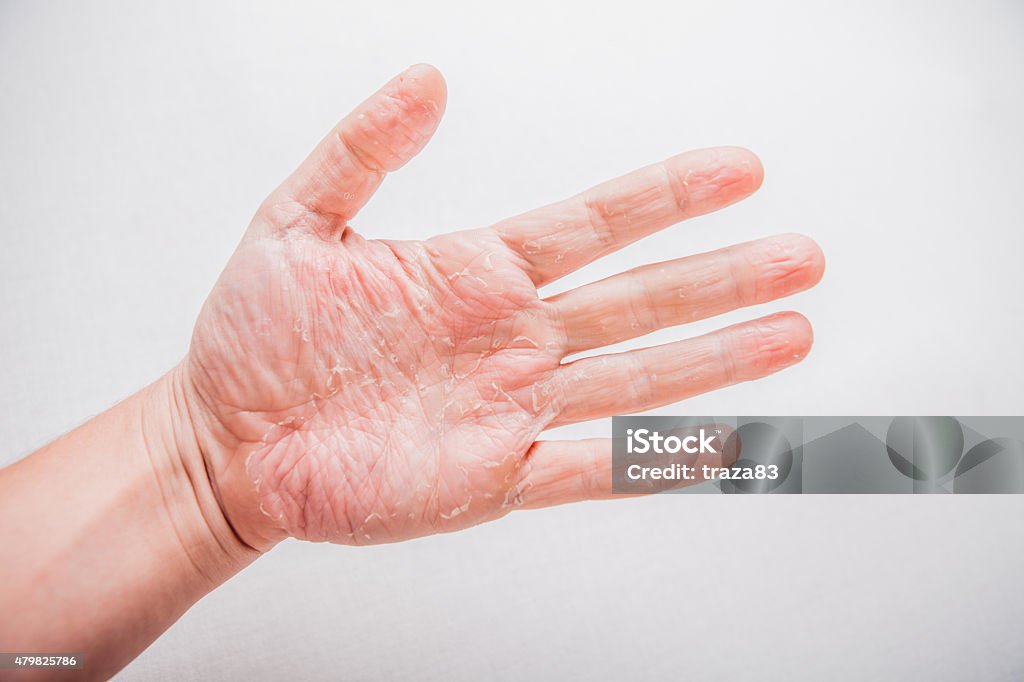 The problem with many people - eczema on hand. Isolated The problem with many people - eczema on hand. Isolated background. 2015 Stock Photo