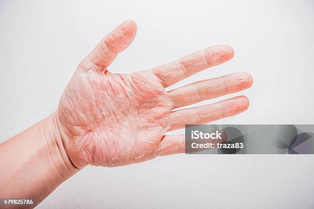 The Problem With Many People Eczema On Hand Isolated Stock Photo - Download Image Now