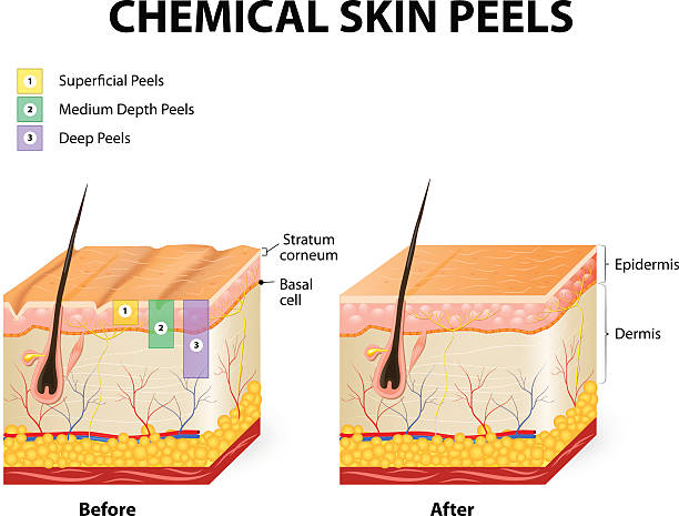 illustrations, cliparts, dessins animés et icônes de peeling chimique - exfoliation