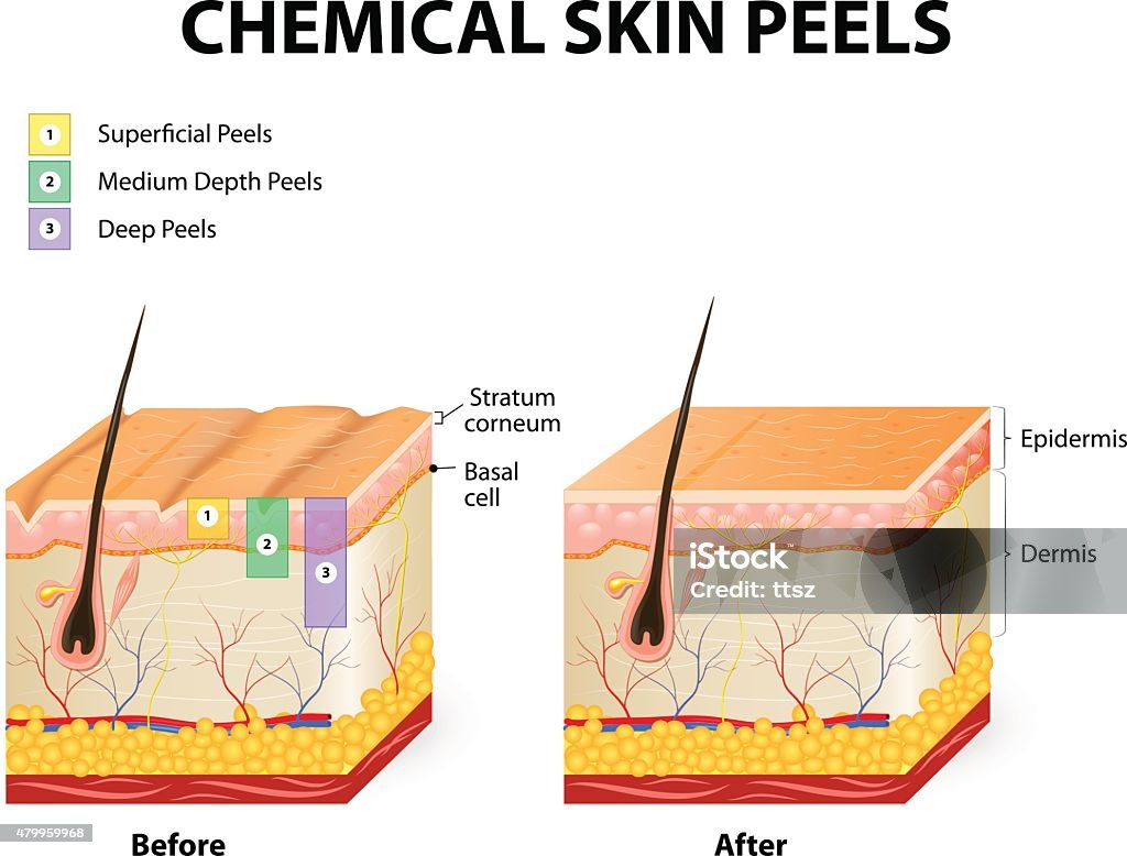 chemical peels chemical peeling or procedure chemexfoliation. Human skin layers Chemical Peel stock vector