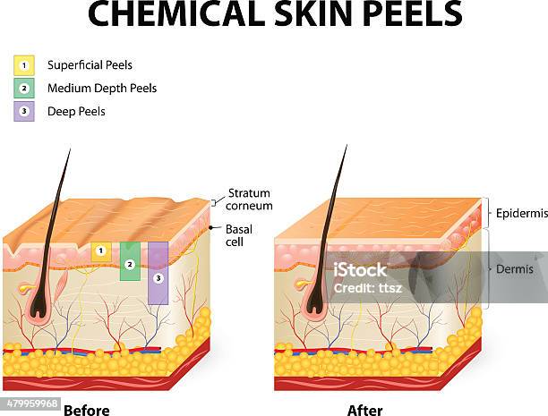 Chemical Peels Stock Illustration - Download Image Now - Chemical Peel, Anatomy, Chemical