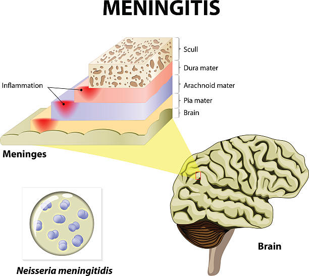 ilustrações, clipart, desenhos animados e ícones de meningite - meningite