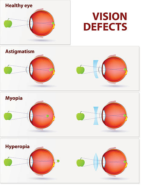 krótkowzroczność, nadwzroczność i astygmatyzm - krótkowzroczność stock illustrations