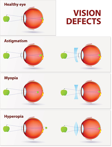 Vision disorders. Astigmatism, Myopia and Hyperopia