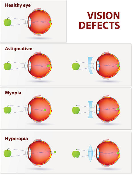 Astigmatism, Myopia and Hyperopia Vision disorders. Astigmatism, Myopia and Hyperopia myopia stock illustrations